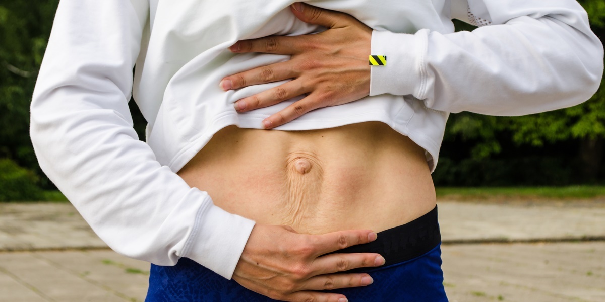 Rozejście mięśnia prostego brzucha (Diastasis Recti) – czym jest?