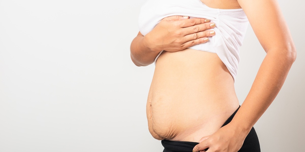Wystający brzuch po ciąży – możliwe przyczyny i postępowanie